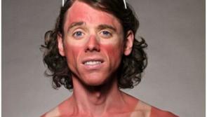 COLUMN: Someone get out the aloe vera -  the whole country is burnt to a crisp