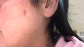 GRAPHIC IMAGES: Longford physiotherapist warns about dangers of skin cancer following surgery