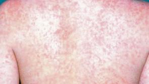 HSE urges parents to make sure children and young people are vaccinated against measles