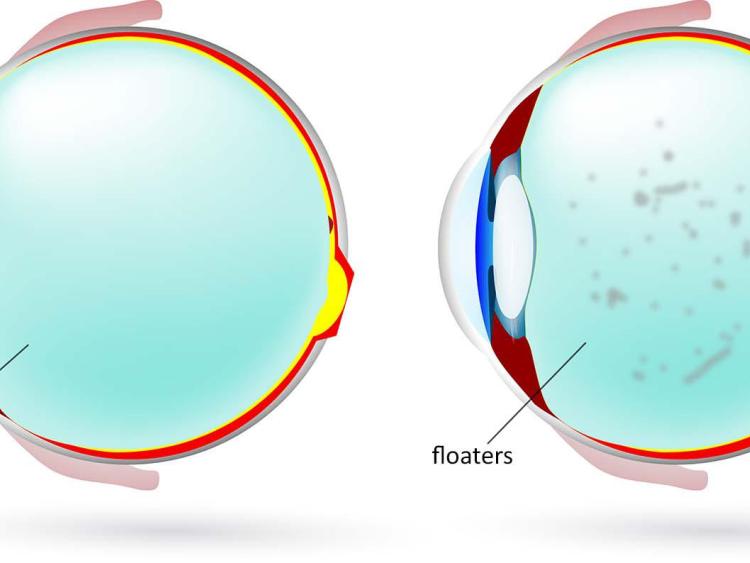Taking care of your eyes What are floaters? Leitrim Observer