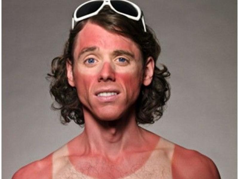COLUMN: Someone get out the aloe vera -  the whole country is burnt to a crisp