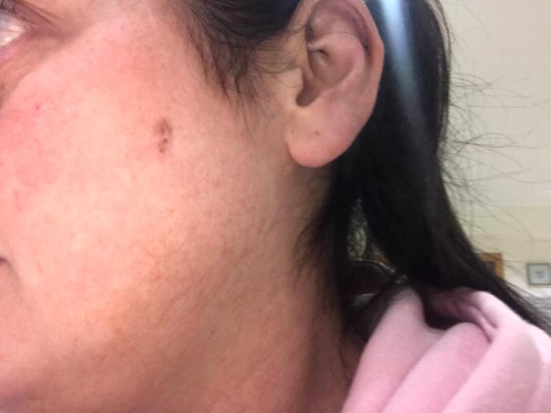 GRAPHIC IMAGES: Longford physiotherapist warns about dangers of skin cancer following surgery