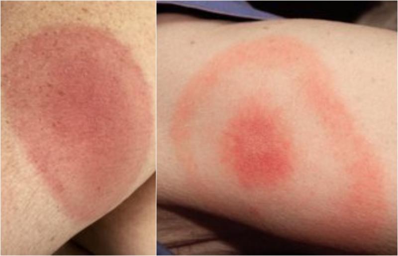 HSE warning as they share pictures of odd rash that could signal deadly infection