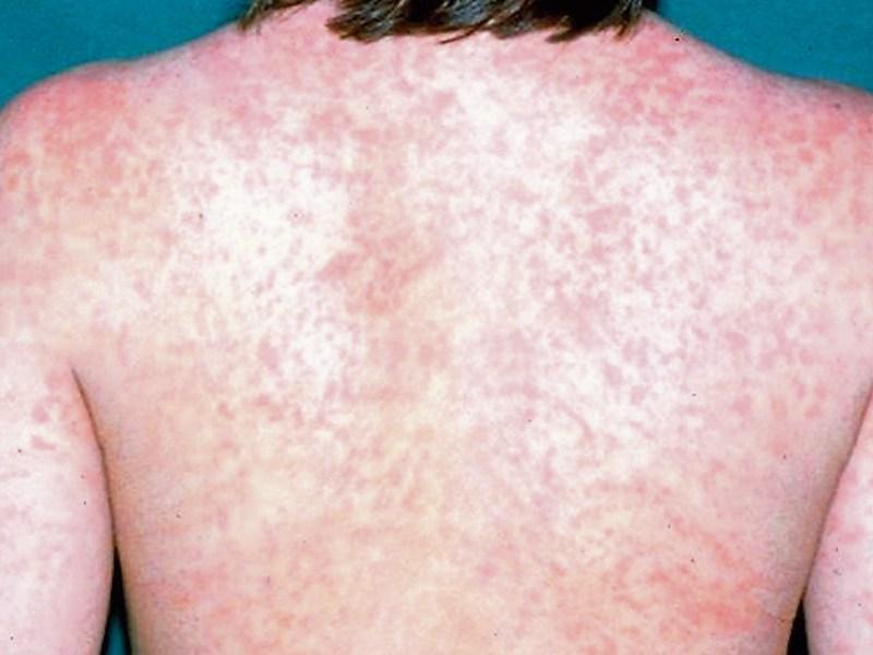 Kildare parents warned over measles cases